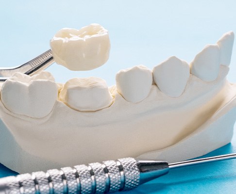 A single restoration to indicate the cost of dental crowns in Silver Spring