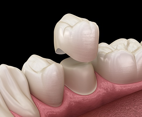 A dental crown is a prosthetic that fits over your child’s existing tooth like a cap