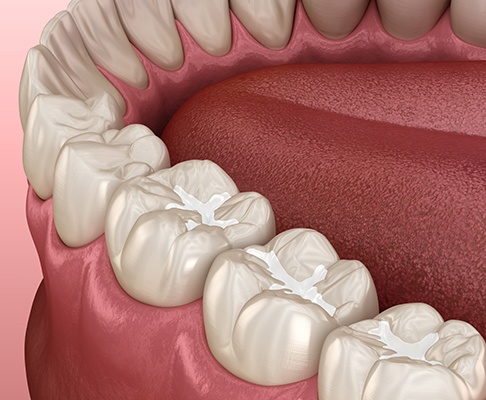 Tooth-colored fillings