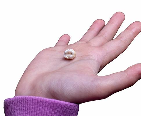 Extracted tooth in palm of child’s hand
