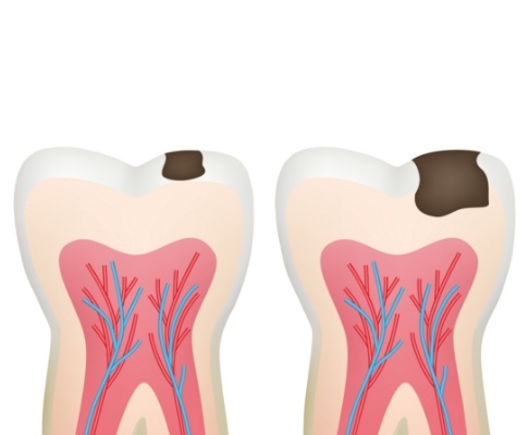 Animated tooth with decay prior to pulpotomy treatment
