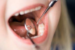 Close up of a child's mouth during dental exam